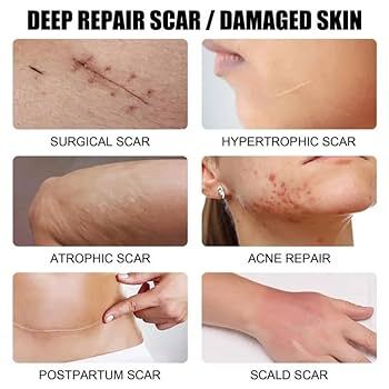 Gentacin 0.1% ointment used for scar fading and infection prevention