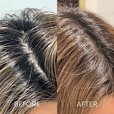 Reducing dandruff and scalp buildup with CHEEKYGLO scalp scrubber